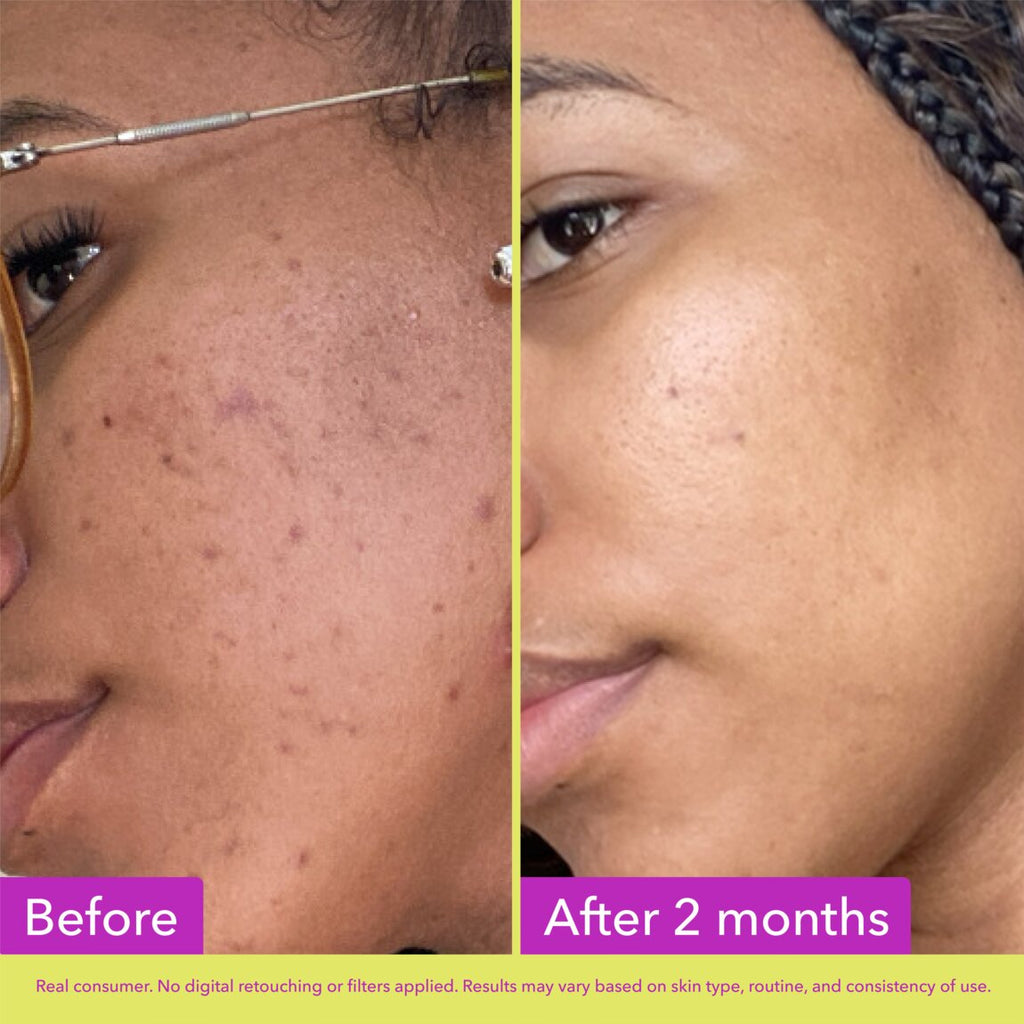 10% Azelaic Acid Treatment Y6