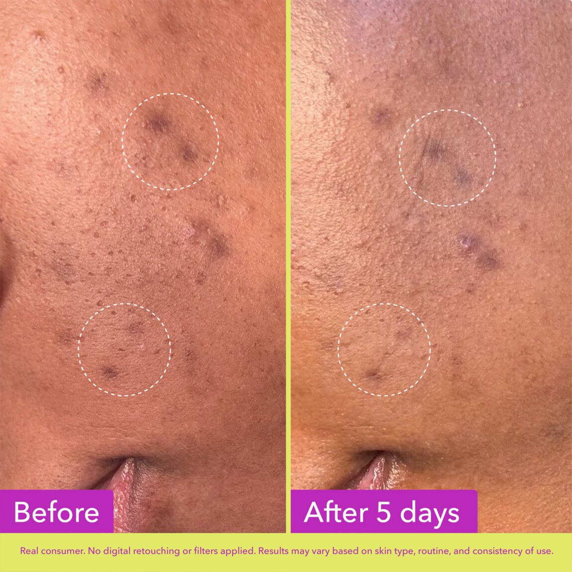 Dark Spot Microdart Patches S7