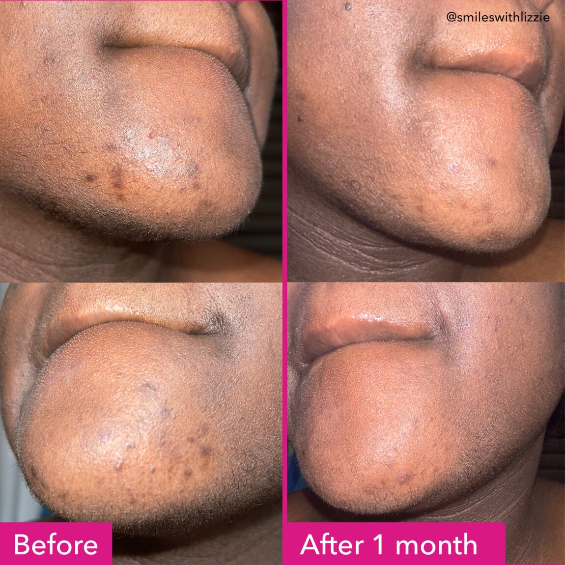 Brightening & Dark Spots Bar P9