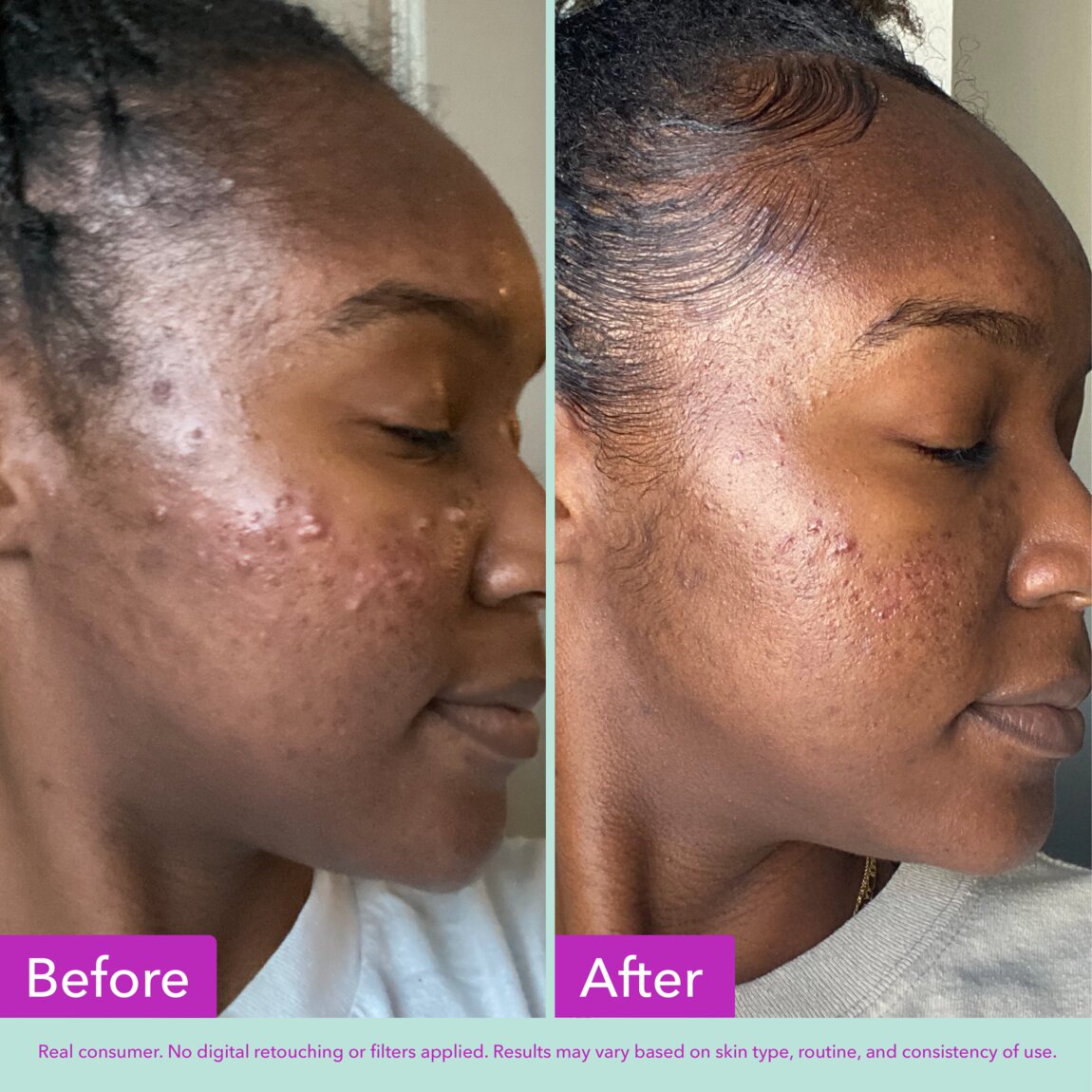 Acne Foaming Cleanser J5
