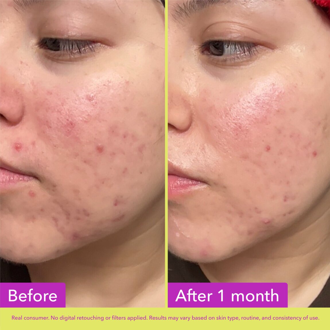 10% Azelaic Acid Treatment Y6