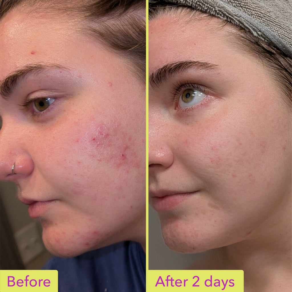 10% Azelaic Acid Treatment Y6
